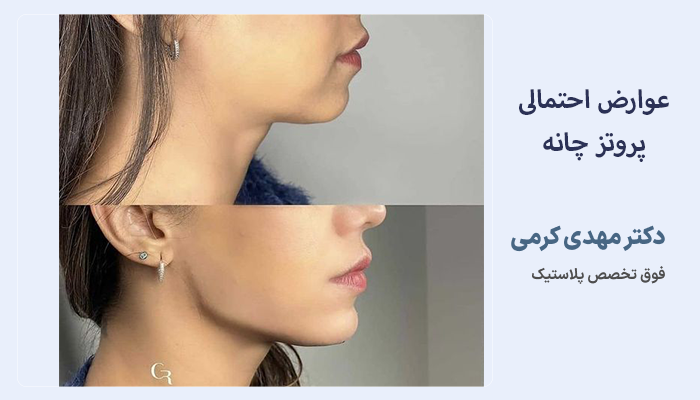 عوارض احتمالی پروتز چانه