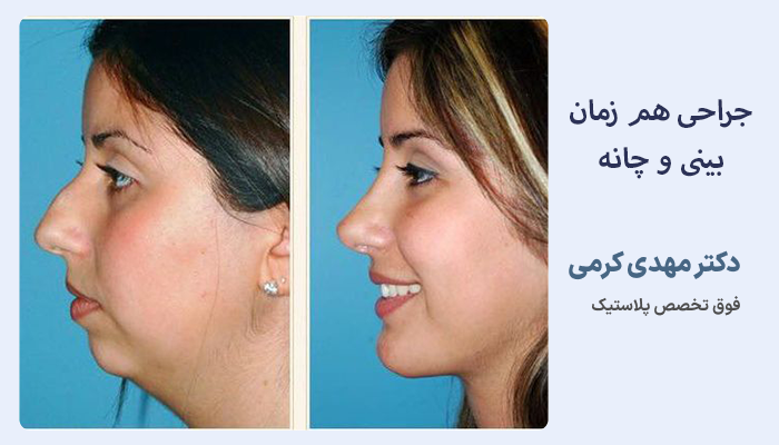 عکس جراحی هم زمان بینی و چانه