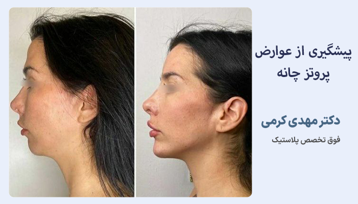 پیشگیری از عوارض پروتز چانه