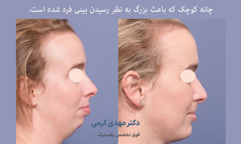 چانه کوچک که باعث بزرگ به نظر رسیدن بینی فرد شده است