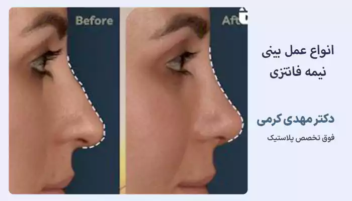 انواع عمل بینی نیمه فانتزی