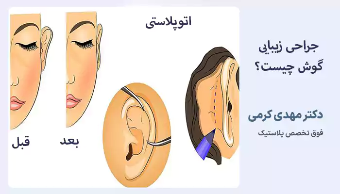 جراحی زیبایی گوش چیست؟