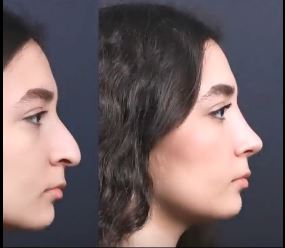 هزینه تیپ پلاستی