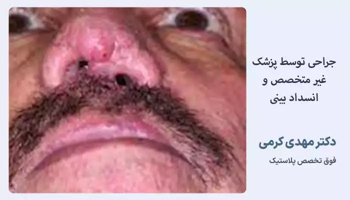 انسداد بینی