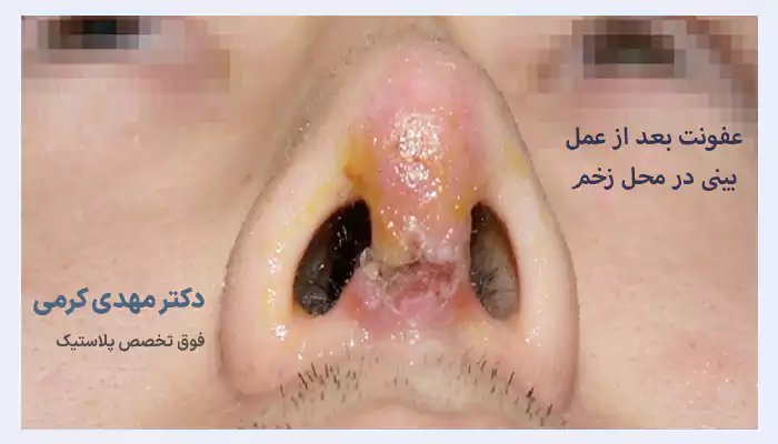 عفونت بعد از عمل بینی در محل زخم