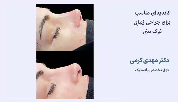 کاندیدای مناسب برای جراحی زیبایی نوک بینی