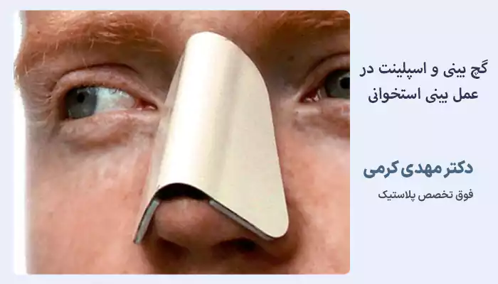 گچ بینی و اسپلینت در عمل بینی استخوانی