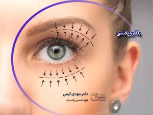 بلفاروپلاستی