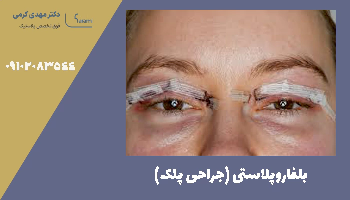 بلفاروپلاستی (جراحی پلک)