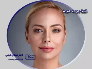 تزریق چربی به صورت
