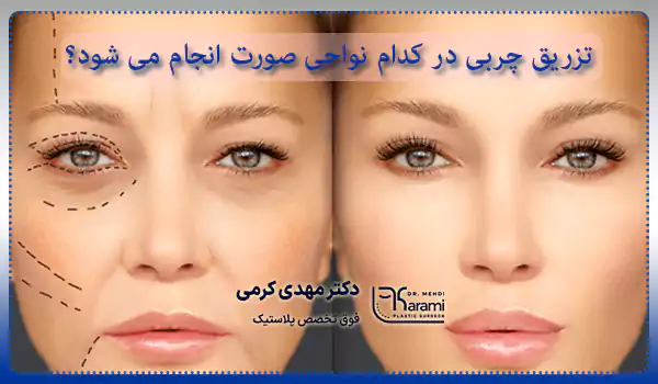 تزریق چربی در کدام نواحی صورت انجام می شود؟