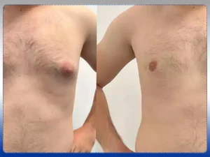 جراحی ژنیکوماستی