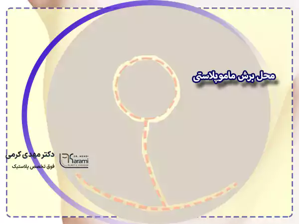 محل برش ماموپلاستی