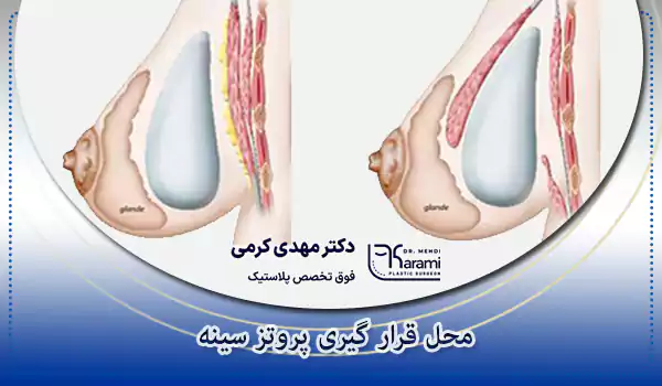محل قرار گیری پروتز سینه