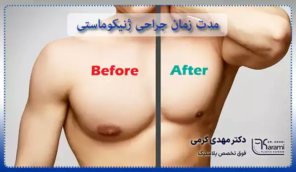 مدت زمان جراحی ژنیکوماستی