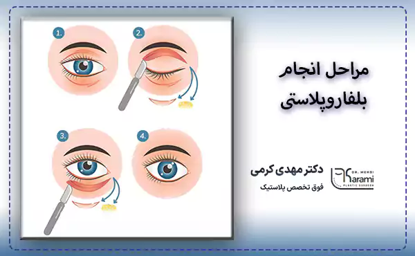 مراحل انجام بلفاروپلاستی