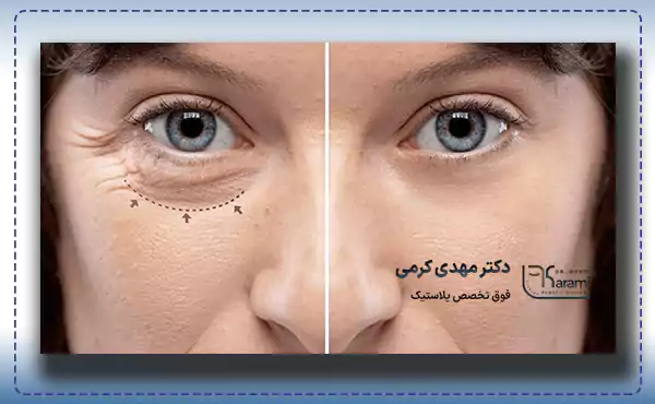 مزایای بلفاروپلاستی