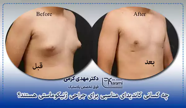 چه کسانی کاندیدای مناسبی برای جراحی ژنیکوماستی هستند؟