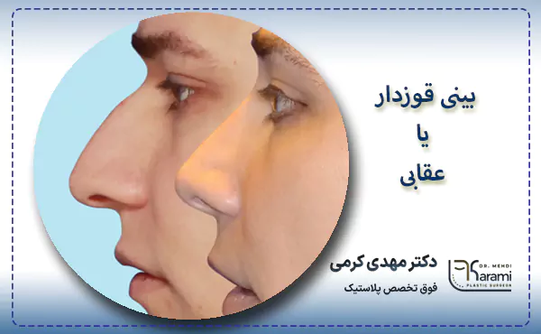 بینی قوزدار یا عقابی