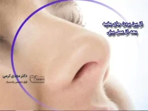 از بین بردن جای بخیه بعد از عمل بینی