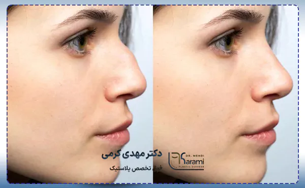 عمل بینی قوزدار