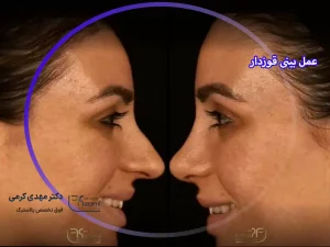 عمل بینی قوزدار