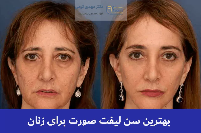 بهترین سن لیفت صورت برای زنان