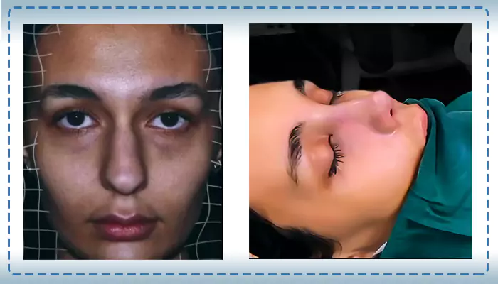 نمونه کار جراحی بینی قبل و بعد دکتر مهدی کرمی