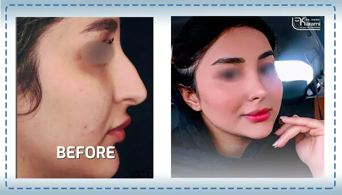 نمونه کار عمل بینی استخوانی دکتر مهدی کرمی