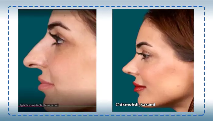 نمونه کار بینی استخوانی