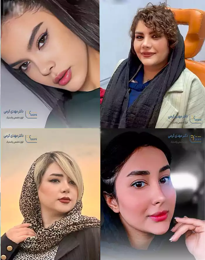 بهترین نمونه کارهای رینوپلاستی دکتر مهدی کرمی