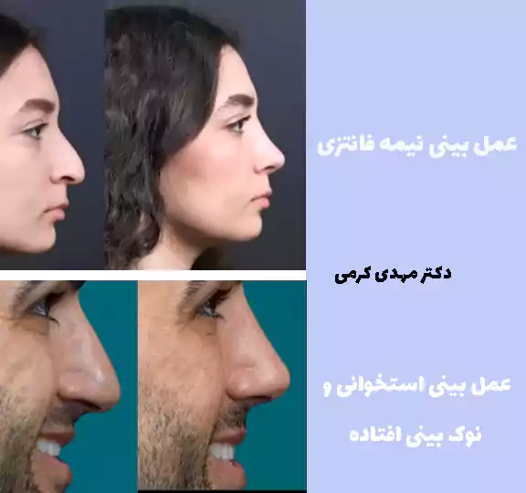 جراحی بینی نمونه کار دکتر مهدی کرمی