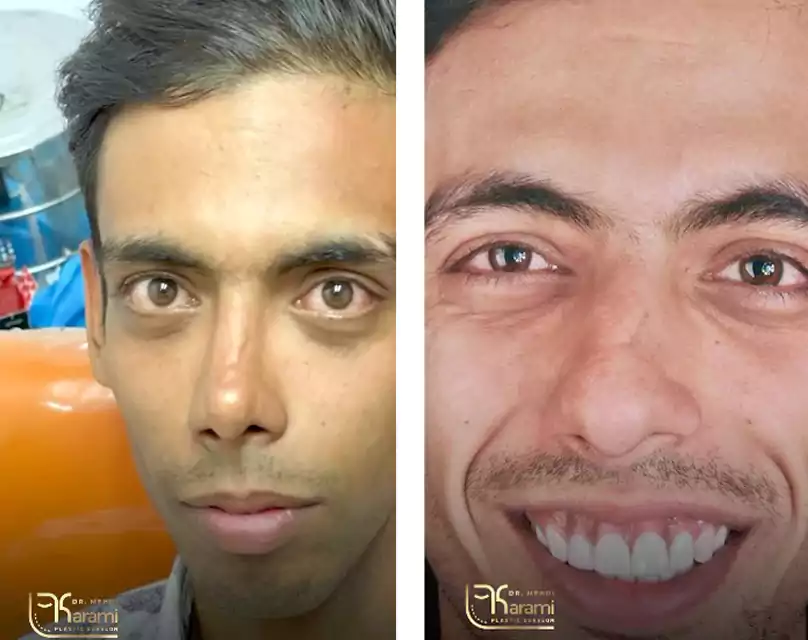 نمونه کار عمل بینی دکتر مهدی کرمی دماغ بسیار مشکل دار